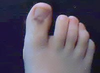 Smashed toe